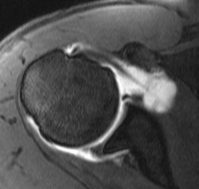 MRI Anterior Bankart